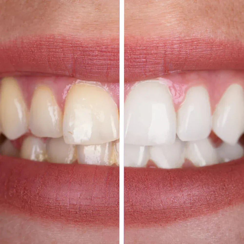 SmileVibe™ | Ultrasone Tandreiniger Voor Thuis